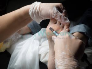 Ayak Mantarı Nedir?